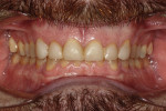 Figure 7 Retracted MIP of composite “test teeth.”