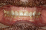 Figure 9 Retracted MIP of completed e.max crowns on teeth Nos. 6 through 11.