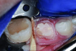 Preparation for zirconia crown. Notice crown configuration was more round than rhomboidal.