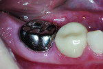 Right buccal view, 14 months after treatment.