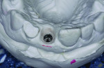 Using the fixture-level impression, the stone is carved to develop an emergence profile that constitutes a “first guess” at the necessary shape for positioning of the free gingival margin and papilla.