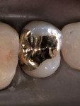 Figure 10  Occlusal view of a cast gold inlay showing control of the embrasures.