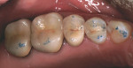 Figure 12  A quadrant of porcelain surfaces (porcelain-fused-to-metal crowns on the molars and porcelain inlays on the bicuspids).