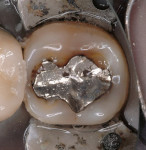 Figure 13  An old amalgam restoration with signs of wear and bruxism.