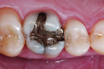 Pretreatment view of old, insufficient amalgam restoration in a first upper molar.