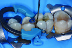 Determination of the maximum cavity depth with a scaled periodontal probe.