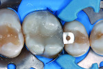 View after building up the occlusal surface.