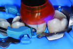 Polymerization of the occlusal composite layer for 10 seconds.