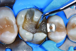x-tra fil composite (VOCO) was applied into the cavity in a 4-mm layer using the bulk technique.