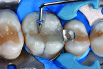 A second increment of x-tra fil composite was used to completely fill the cavity.
