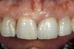 Figure 3 View of the final restoration in this case—a metal-ceramic crown to block out the previously existing metal post and core. Achieving a match such as this with the adjacent natural dentition may require the fabrication of several crowns.