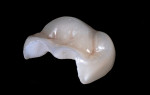 Milled by Burbank Dental Laboratory, this monolithic e.max crown was scanned using the 3Shape Trios digital scanner.