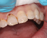 In places where dentin thickness was suspected to be less than 0.5 mm, a thin insulating liner of ACTIVA Base/Liner was placed and light cured for 20 seconds.