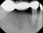 Case 1 post-treatment radiograph showing 3-mm postsurgical probing depth on tooth No. 29 at 5 years.