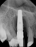 Case 4 pretreatment radiograph showing failing implant in tooth position No. 6.