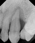 Case 3 pretreatment radiograph showing 14-mm probing depths on distolingual aspects of tooth No. 6.