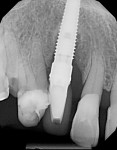 Post-treatment radiograph showing 3-mm probing depths at 14-month follow-up.