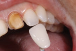 The shade of the natural dentition was determined using tooth No. 7.