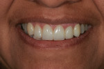 The post-restorative treatment full smile reflects a more pleasing smile.