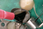 Figure 8 A dentin/enamel bonding resin was placed.