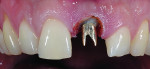 Fig 9. Once the tissue was trimmed to the desired height, a custom temporary abutment was placed to preserve the new tissue contour.