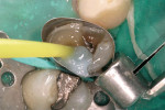 Figure 10 The blue CosmeCore material was injected into the preparation.