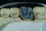 Fig 1. Occlusal view of the full-contour crown restoration wax-up.