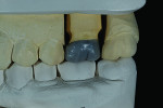 Fig 2. Buccal view of the full-contour crown restoration wax-up.