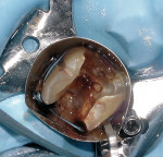 Figure 1  Image showing severe coronal breakdown of a lower molar requiring endodontic therapy.