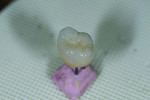 Fig 25. To characterize the incisal, dark blue stain was applied, in addition to a combination of Blue and Pink, and a slight amount of Shade 4 was placed in the central occlusal groove.