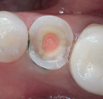 Figure 3  View of the temporary restoration using a glass ionomer (Fugi Triage® Pink, GC America, Inc.) to seal endodontic access.