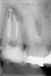 Figure 4  Placement of an immediate coronal restoration with a glass ionomer (Fugi IX,™ GC America, Inc.) following endodontic therapy, with evident periapical lesion. (Courtesy of Dr. Martin Trope)