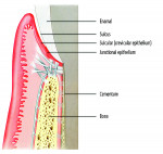 Fig 1 and Fig 2. Attachment of the soft tissues to tooth (Fig 1). Note the fibers go into the cementum at the root. This is very robust, holding the soft tissues to form a seal. Implant site (Fig 2). Here hemidesmosomes hold only the tissue. It is far more fragile than with a tooth. Consider this to be like a cuff. (Used with permission from Elsevier Mosby.)