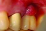 Fig 3 through Fig 6. Typical clinical examples of cement-induced peri-implant disease. (Fig 3 through Fig 5 used with permission from Springer Berlin Heidelbeg.)