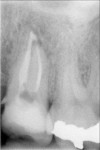 Figure 5  The coronal seal has been maintained, allowing apical healing of periapical lesion 1 year following treatment. (Courtesy of Dr. Martin Trope)