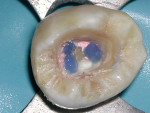 Figure 7  To assist in locating the orifices at a later time, a contrasting color, light-cure resin was applied over each orifice and cured.