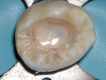 Figure 8  The entire pulpal floor was covered with a flowable composite and cured.