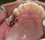 Figure 5 Palatal flap elevated and advanced to buccal—occlusal view (Fig 5) and buccal view (Fig 6).