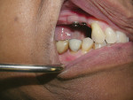 Figure 7 Healed collars at 8 weeks—buccal view.