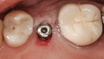 Figure 2 Punch uncovering of implant with healing abutment in place.