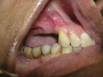 Figure 4 Healed site with no keratinized mucosa—buccal view.