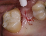 Figure 9 U-shaped incision around implant outline.