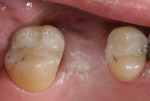 Figure 8 Site with inadequate buccal thickness
of KM.