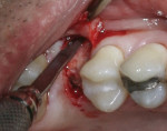 Figure 11 Creation of buccal pouch with mini-scalpel.
