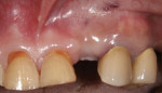 Figure 20 Maxillary left lateral incisor implant with inadequate buccal thickness along full length.