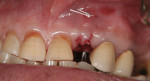 Figure 22 Pedicle tucked into buccal pouch and secured with internal sling suture.