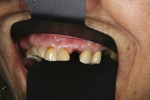 Figure 24 Occlusal view after 3 months with dramatic increase in thickness.