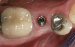 Figure 19 Significant increase in width and thickness of buccal KM after 4 months.