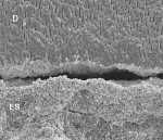 Figure 11  SEM demonstrating microgap formation with AH 26 epoxy sealer due to polymerization shrinkage. (ES - epoxy sealer; D - dentin)