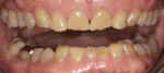 Figure 5 Upper and lower arch appearance in 2004 (Fig 4) compared to 2014 (Fig 5). Note the similar appearance in the wear and chipping of teeth 10 years later.